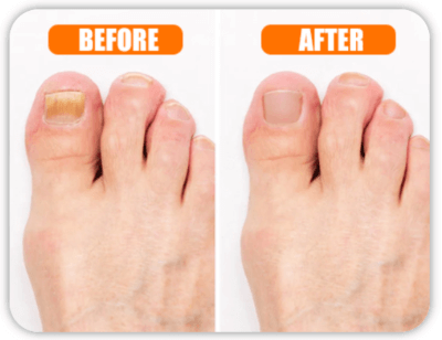 Hewelth BioClear Nails Before And After
