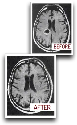 Meridian Health Protocol Before and After