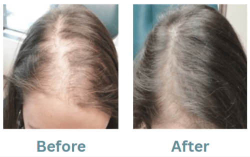 Revifol Before and After